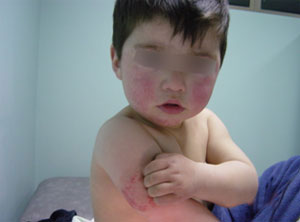 Dermatitis Atópica