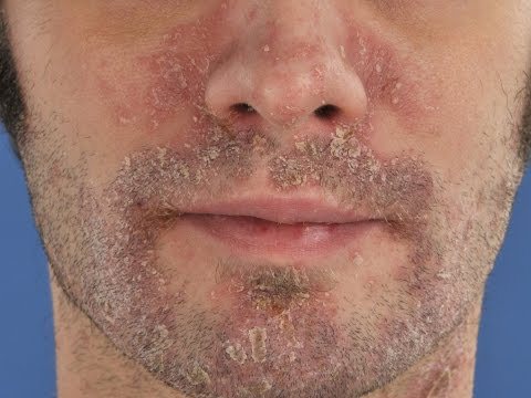 Dermatitis Seborreica