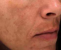 Melasma Facial