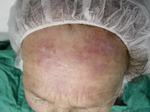 Queratosis Actínicas